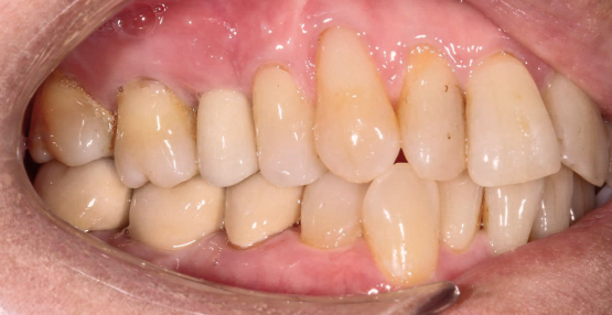 Клинический случай №1 Тотальная реставрация керамическими коронками и винирами